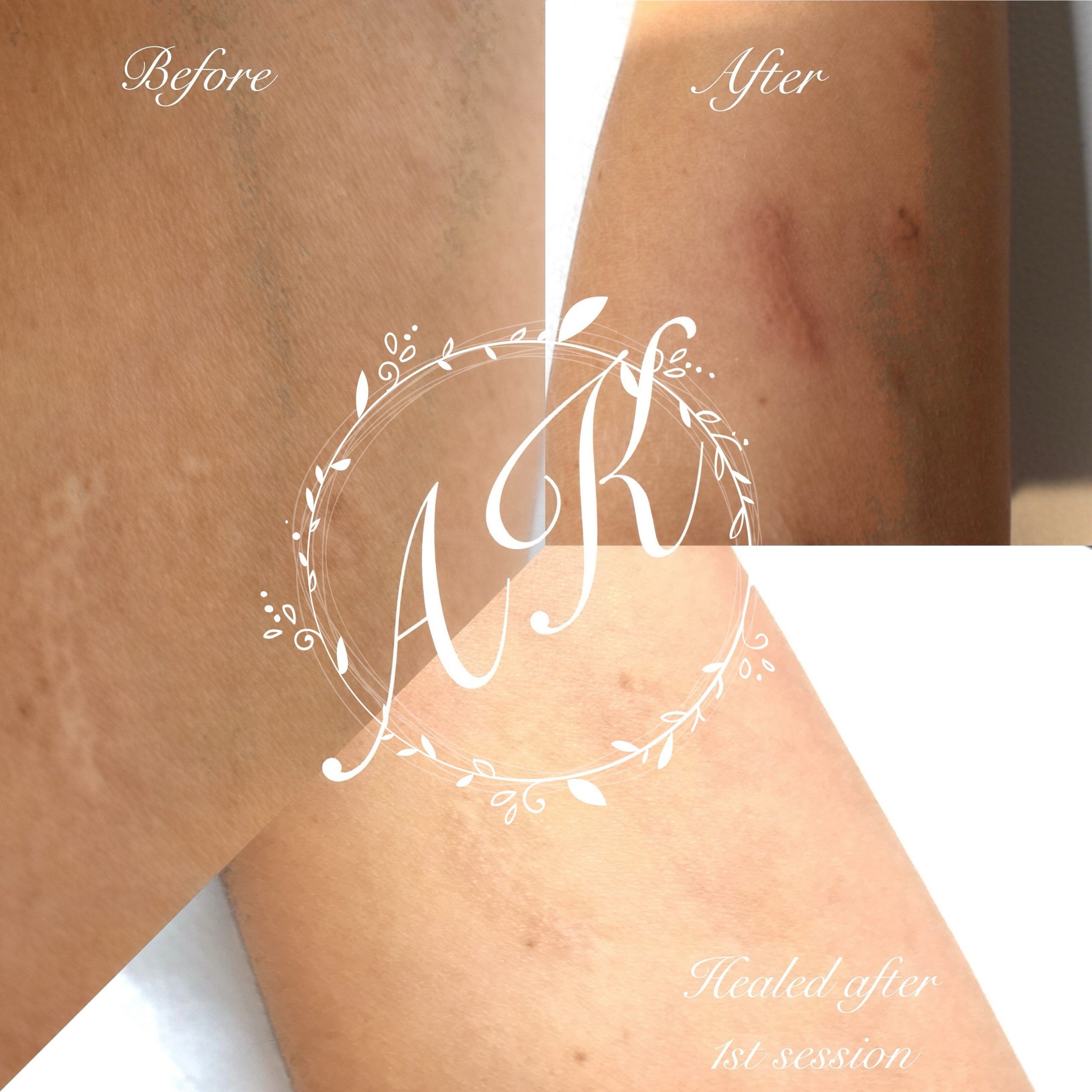Laser Treatment Before and After Photos - Total Body Laser & Med Spa |  Madison Wisconsin